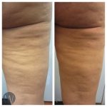 cellulaze before and after