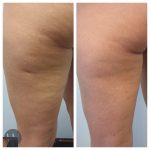 cellulaze before and after