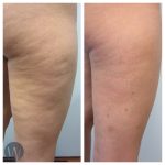 cellulaze before and after