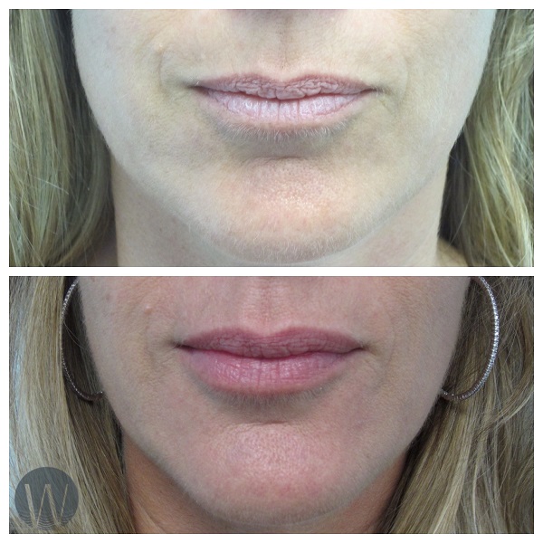 lip rejuvenation before and after