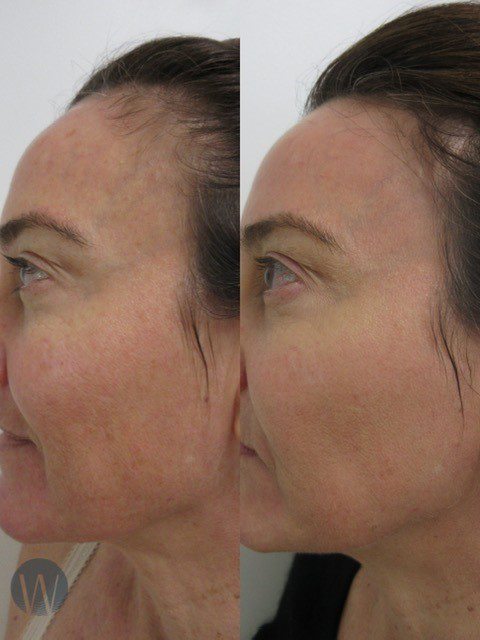laser skin resurfacing before and after
