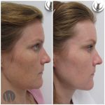 laser skin resurfacing before and after