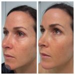 laser skin resurfacing before and after