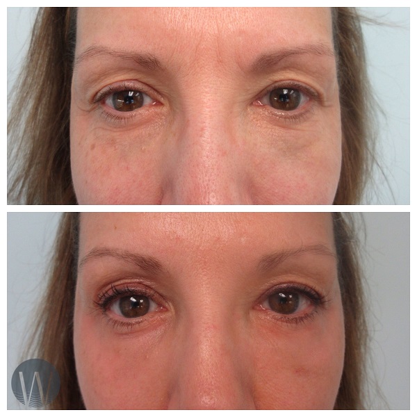 laser skin resurfacing before and after