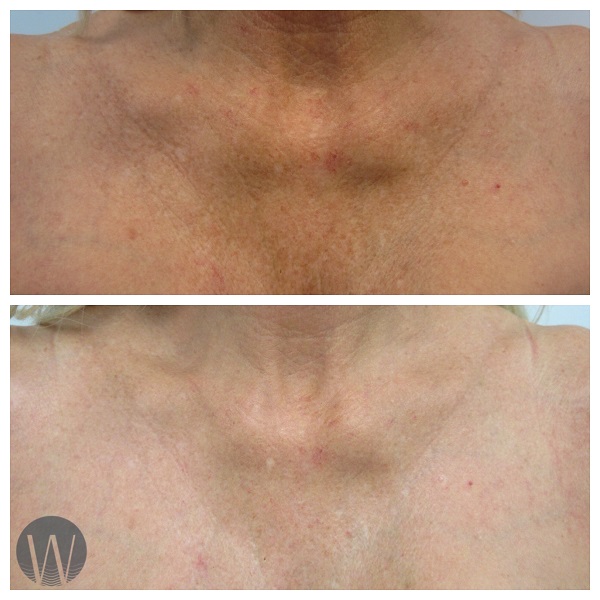 laser skin resurfacing before and after