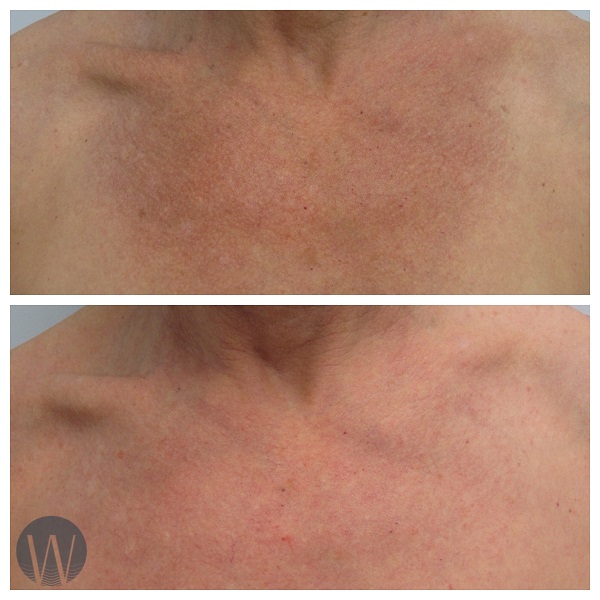 laser skin resurfacing before and after