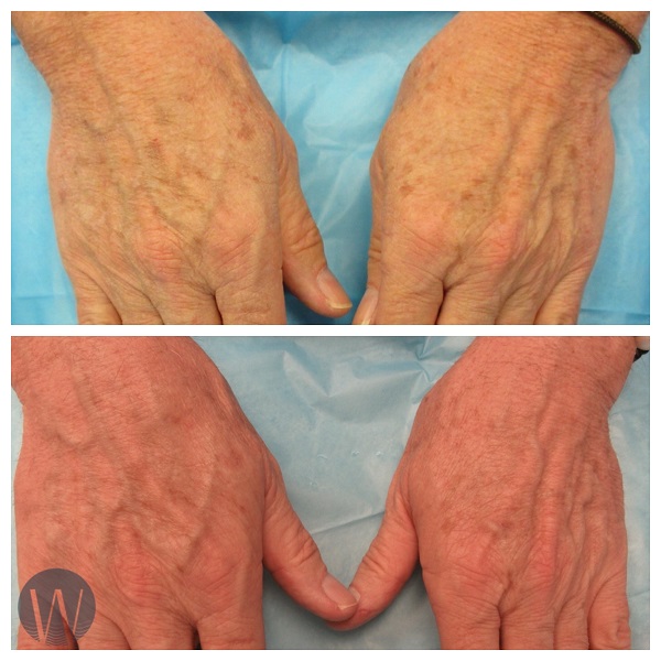 laser skin resurfacing before and after