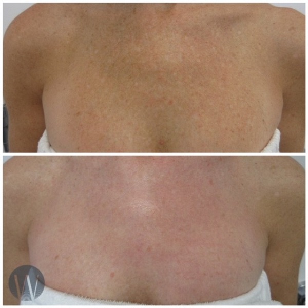 laser skin resurfacing before and after