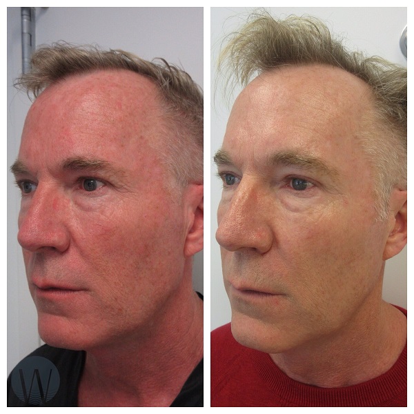 laser skin resurfacing before and after