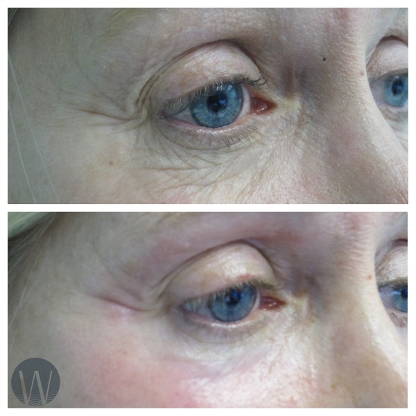 laser skin resurfacing before and after