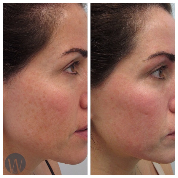 laser skin resurfacing before and after