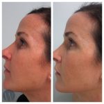laser skin resurfacing before and after