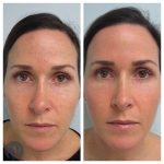 laser skin resurfacing before and after