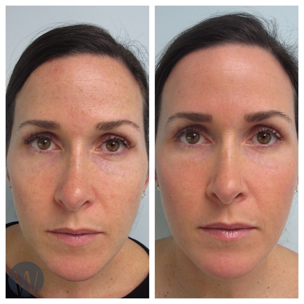 laser skin resurfacing before and after