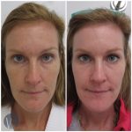 laser skin resurfacing before and after front view case 4529