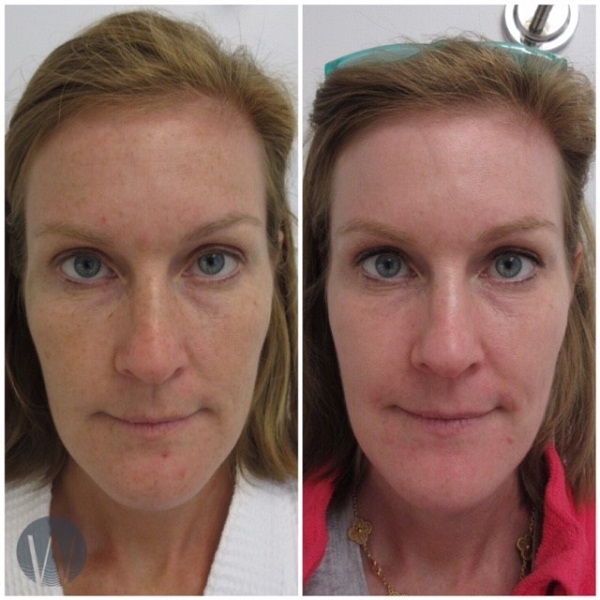 laser skin resurfacing before and after front view case 4529