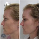 laser skin resurfacing before and after side view case 4530