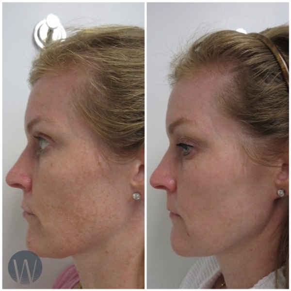 laser skin resurfacing before and after side view case 4530