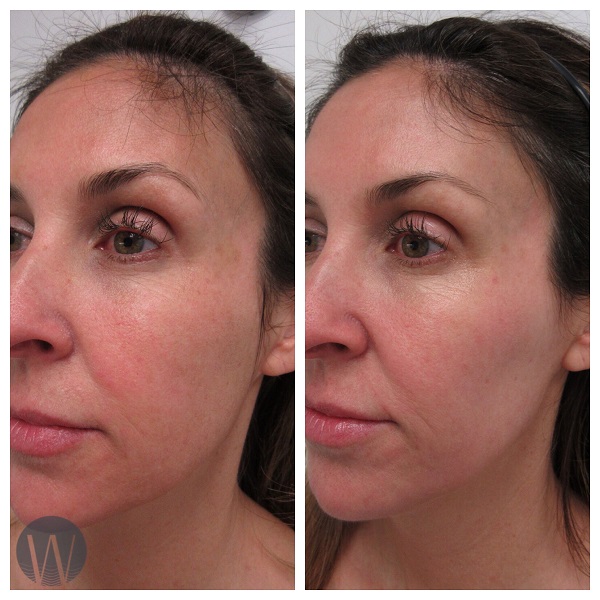 laser skin resurfacing before and after angle view case 4532