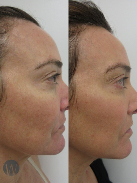laser skin resurfacing before and after side view case 4213