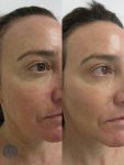 laser skin resurfacing before and after right angle case 4565
