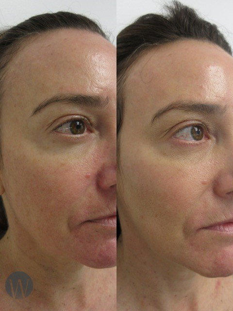 laser skin resurfacing before and after right angle case 4565