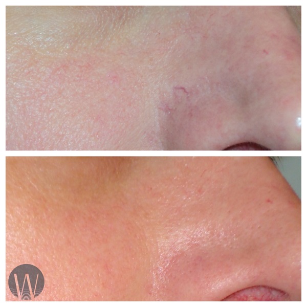 rosacea treatment before and after