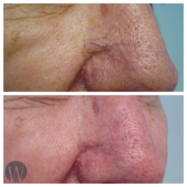 rosacea treatment before and after