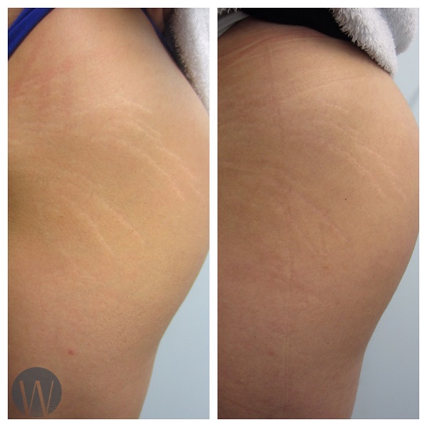 scar revision before and after