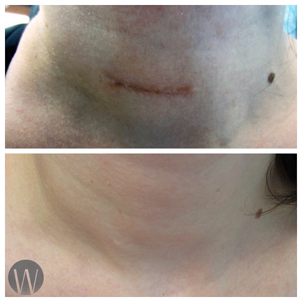 scar revision before and after