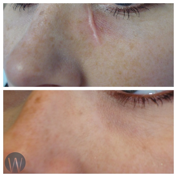 scar revision before and after