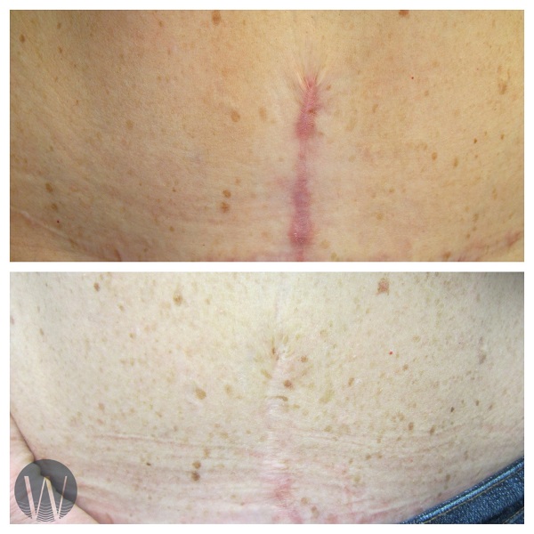 scar revision before and after