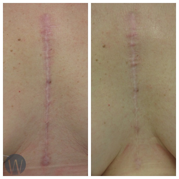 scar revision before and after