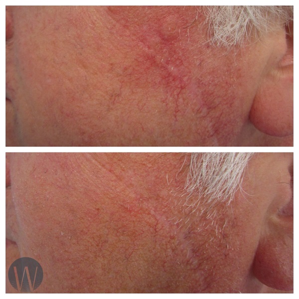 scar revision before and after
