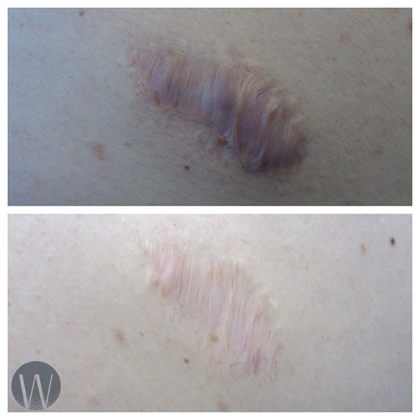 scar revision before and after