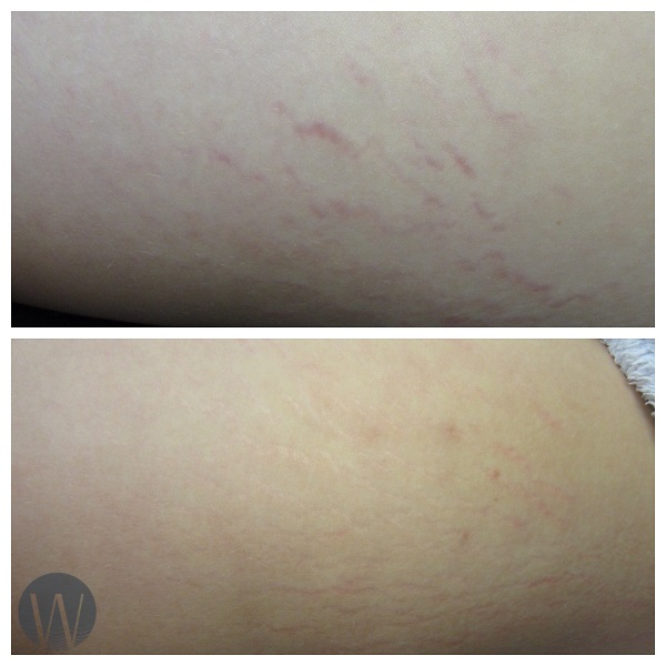 scar revision before and after
