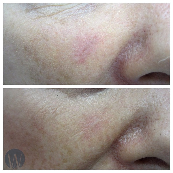 scar revision before and after