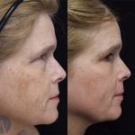 before and after laser skin resurfacing side face view case 6009