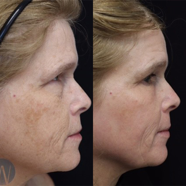 before and after laser skin resurfacing side face view case 6009