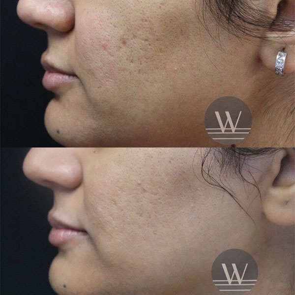 before and after acne scar treatment side face view case 7187