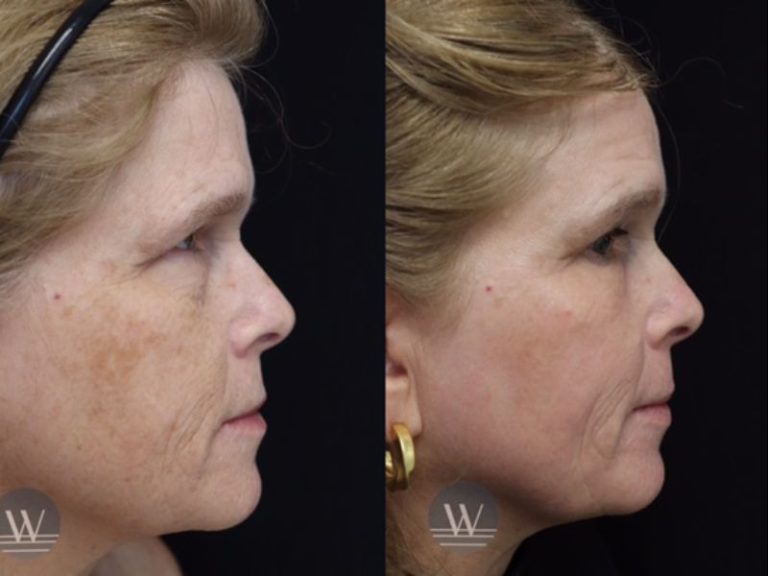 before and after brown spot and birthmark treatment side face view case 7197