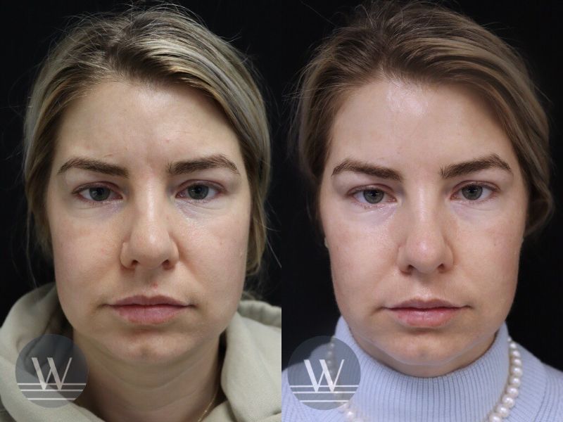 before and after facelift in a syringe front view case 7254