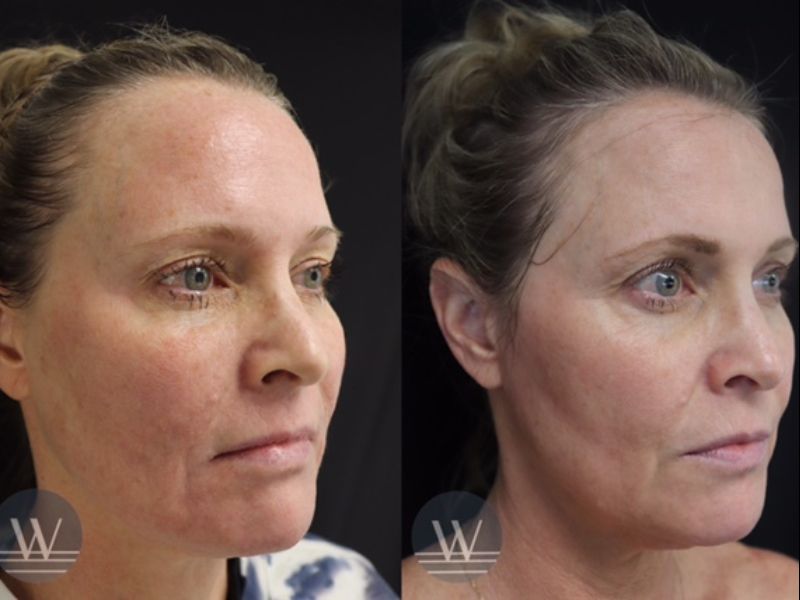 before and after laser skin resurfacing angle face view case 7252