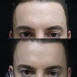 before and after daxxify forehead view case 7301