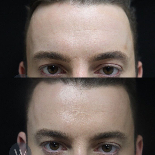 before and after daxxify forehead view case 7301