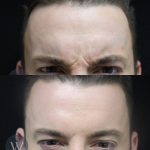 before and after daxxify forehead view case 7302