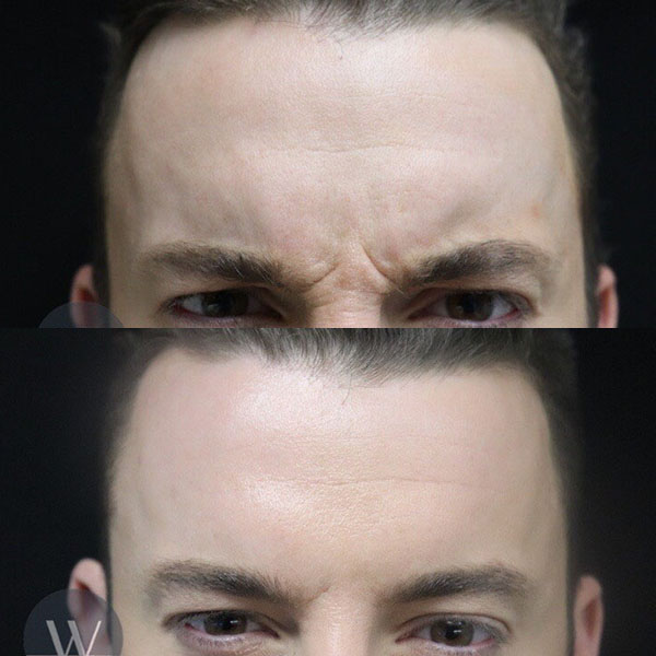 before and after daxxify forehead view case 7302