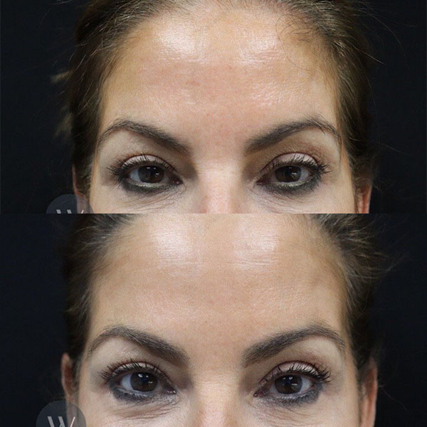 before and after daxxify forehead view case 7306