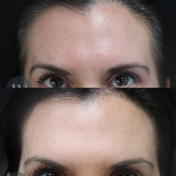 before and after Daxxify forehead view case 7406