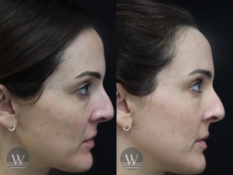 before and after laser skin resurfacing side face view case 7415